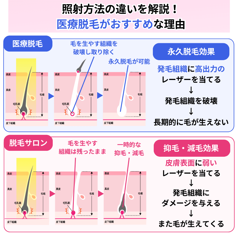 医療脱毛とサロン脱毛の照射方法と毛が抜けるまでの過程の違いを表した図