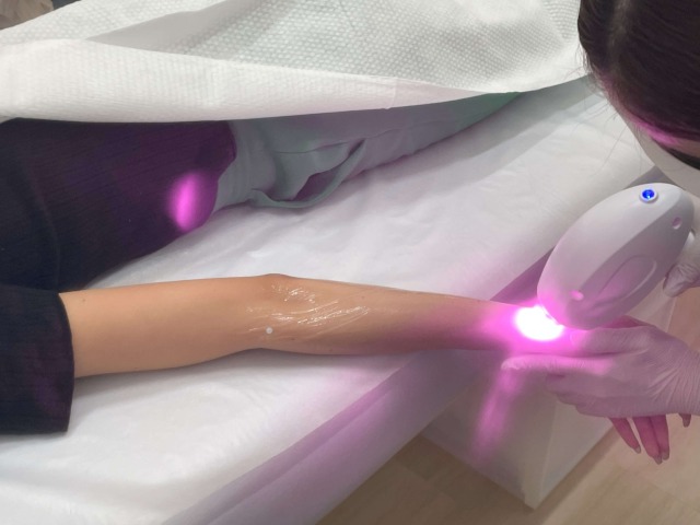 エミナルクリニックで腕の医療脱毛の施術を行けている様子
